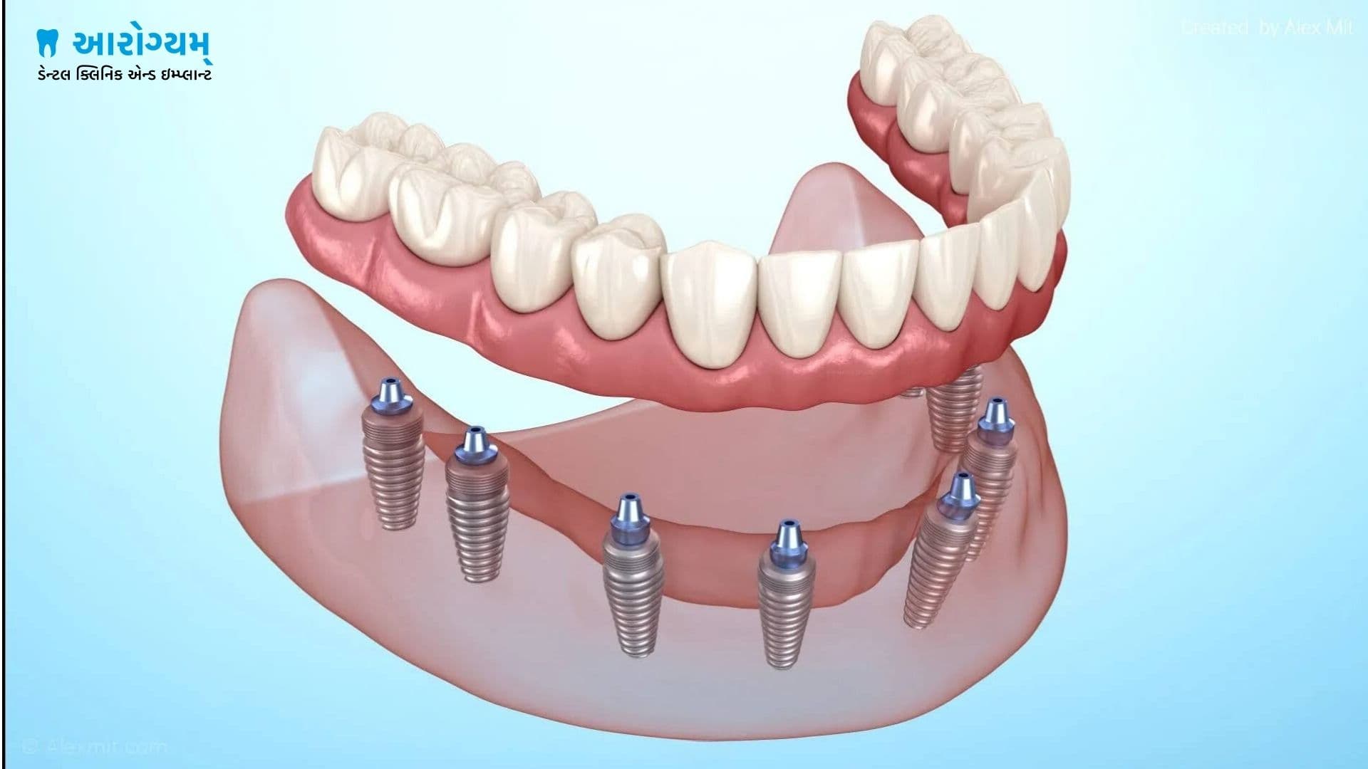 Full mouth fixed dental implants at Aarogyam Dental Clinic, Rajkot