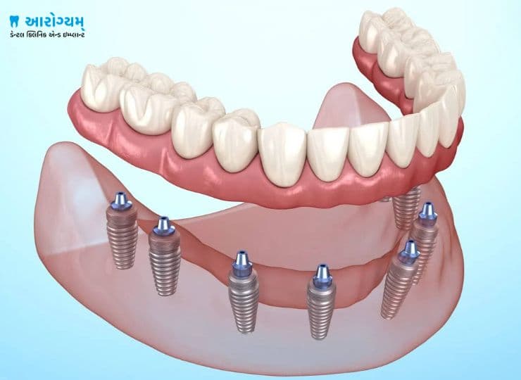 Full Mouth Fixed Teeth Implants
