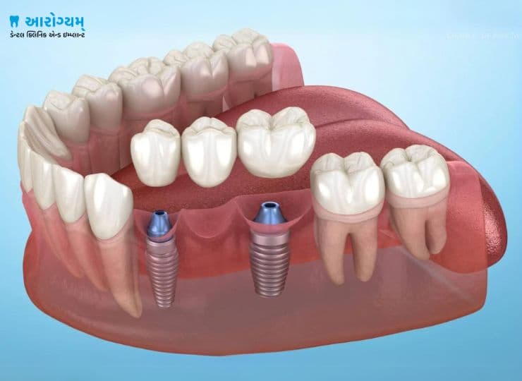 Multiple Teeth Implants