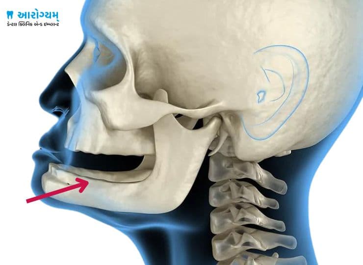 Dental Implants in Poor Bone Condition