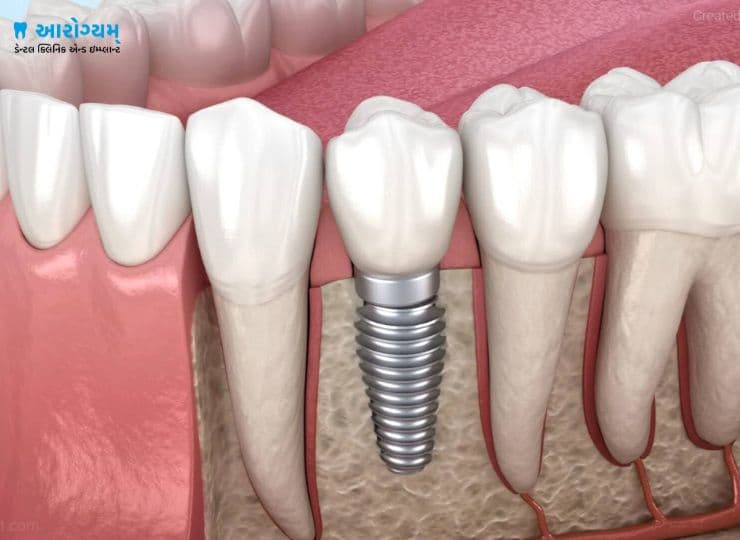 Single Tooth Implant